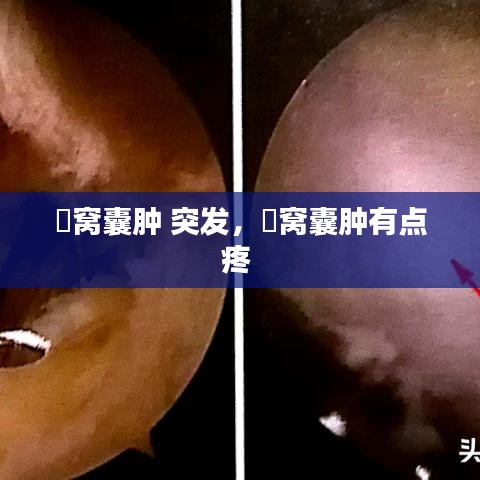 腘窝囊肿 突发，腘窝囊肿有点疼 