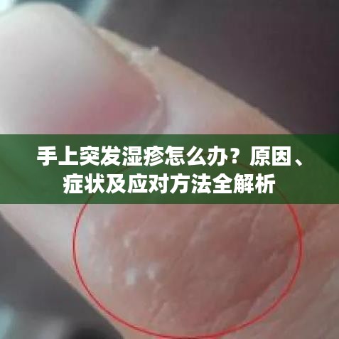 手上突发湿疹怎么办？原因、症状及应对方法全解析