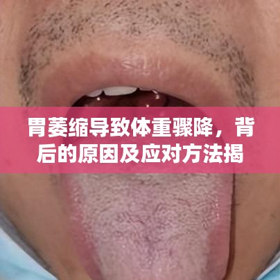 胃萎缩导致体重骤降,背后的原因及应对方法揭秘